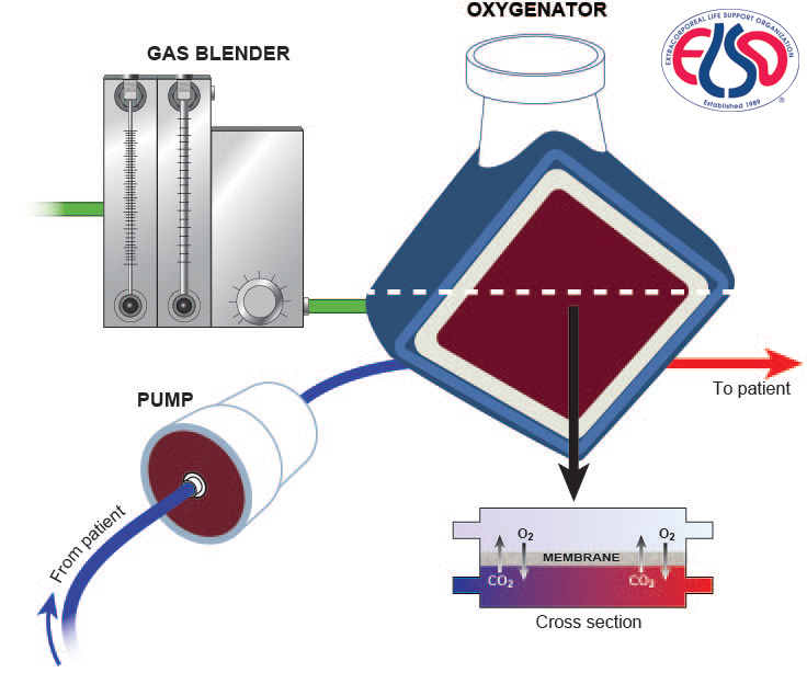 ECMO circuit diagram